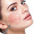 Do you have Rosacea and know how to treat it?